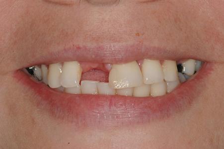 image of a smile missing multiple teeth | Wausau WI