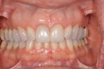 image of the same teeth after crowns and veneers | Wausau WI