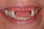 image of smile missing front 4 teeth | Wausau WI