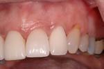 image of the same teeth after crowns and ortho | Wausau WI