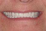 image of a new custom denture | Wausau WI