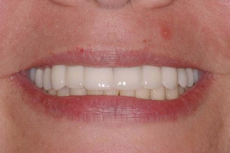 image of the same teeth after implants and crowns | Wausau WI