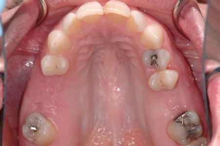 image of smile with silver fillings & missing many teeth | Wausau WI